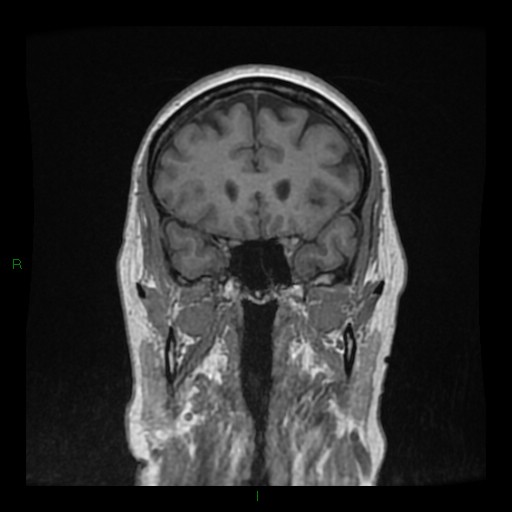 Cerebellar abscess (Radiopaedia 78135-90678 Coronal T1 C+ 51).jpg