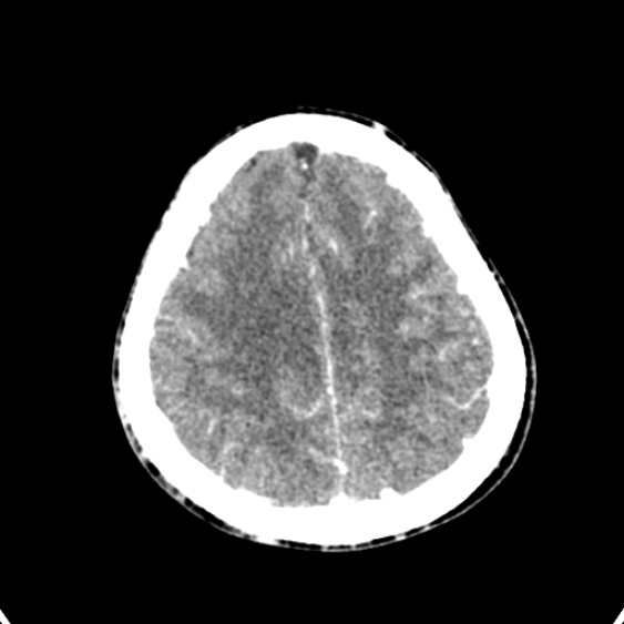 Cerebellar abscess secondary to mastoiditis (Radiopaedia 26284-26412 Axial C+ delayed 126).jpg
