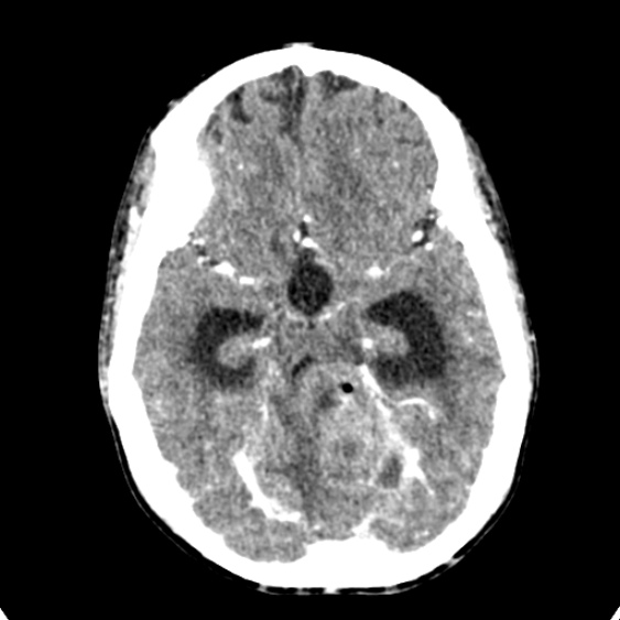 Cerebellar abscess secondary to mastoiditis (Radiopaedia 26284-26412 Axial C+ delayed 58).jpg