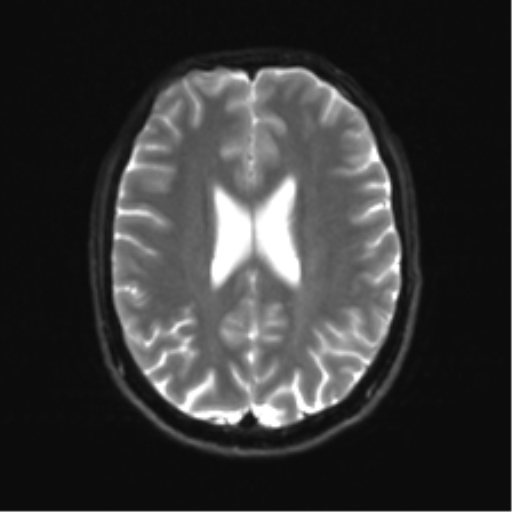 Cerebellar agenesis with hypoplastic pons (pontocerebellar hypoplasia) (Radiopaedia 57224-64138 Axial DWI 25).png