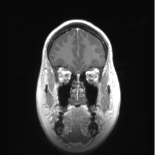 File:Cerebellar ependymoma complicated by post-operative subdural hematoma (Radiopaedia 83322-97736 Coronal T1 C+ 12).png