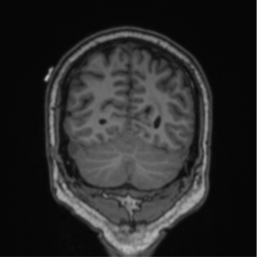 Cerebellar hemangioblastomas and pituitary adenoma (Radiopaedia 85490-101176 Coronal T1 26).png