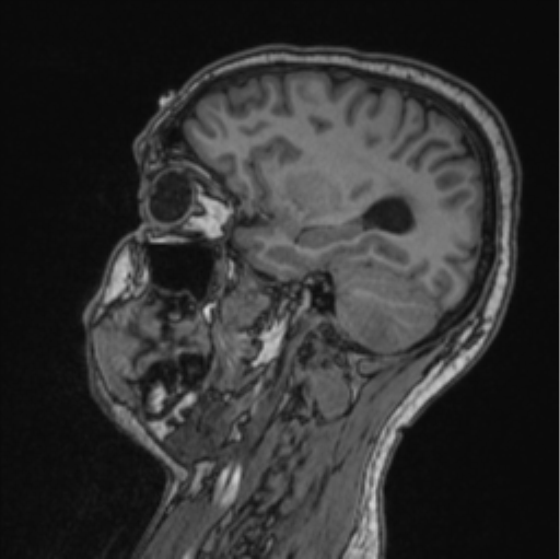 File:Cerebellar hemangioblastomas and pituitary adenoma (Radiopaedia 85490-101176 Sagittal T1 39).png