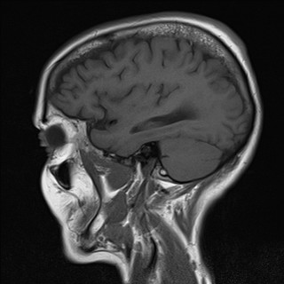 File:Cerebellar metastases (Radiopaedia 24038-24249 Sagittal T1 3).jpg
