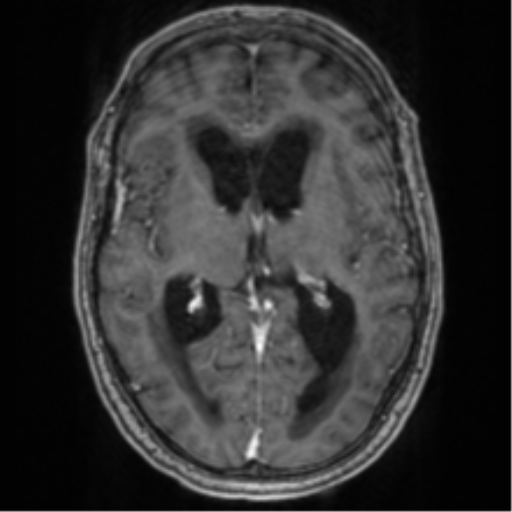 Cerebellar metastasis from lung adenocarcinoma (Radiopaedia 86690-102829 Axial T1 C+ 43).png