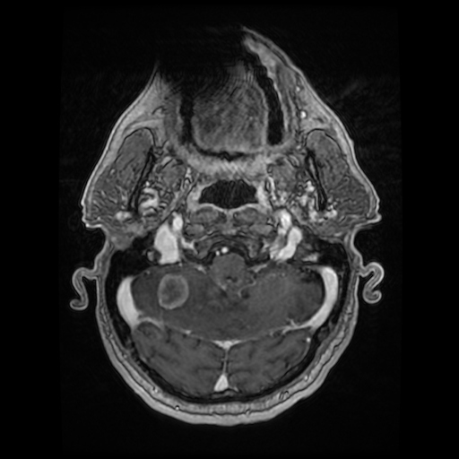 Cerebellar metastasis of pulmonary adenocarcinoma, cavernous venous malformation, and developmental venous anomaly (Radiopaedia 85827-101661 Axial T1 C+ 25).jpg