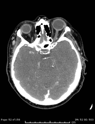 Cerebellar strokes due to intracranial giant cell arteritis (Radiopaedia 68799-78510 CT angiogram 52).jpg