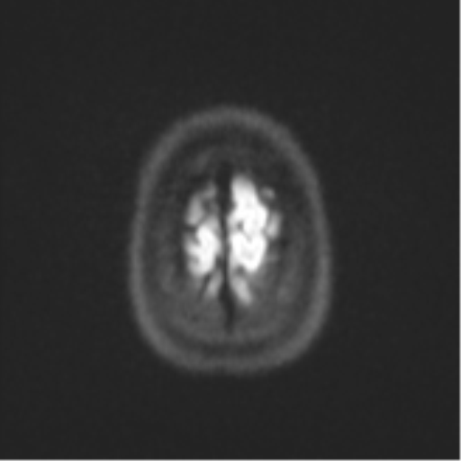 Cerebellar tuberculomas (Radiopaedia 46939-51472 Axial DWI 55).png