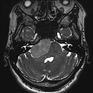 Cerebellopontine angle meningioma (Radiopaedia 72983-83680 Axial FIESTA 30).jpg