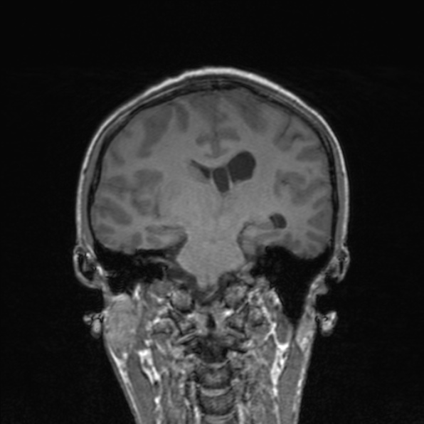 Cerebral abscess (Radiopaedia 24212-24478 Coronal T1 121).jpg