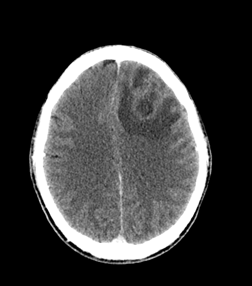 Cerebral abscess (Radiopaedia 57774-64741 Axial C+ delayed 44).png