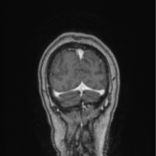 Cerebral abscess from pulmonary arteriovenous malformation (Radiopaedia 86275-102291 L 13).png