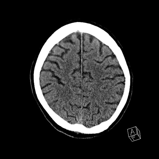 Cerebral abscess with ventriculitis (Radiopaedia 78965-91876 Axial non-contrast 37).jpg
