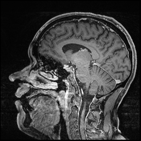 Cerebral abscess with ventriculitis (Radiopaedia 78965-91878 Sagittal T1 C+ 101).jpg