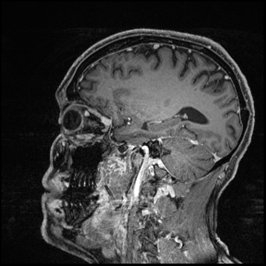 Cerebral abscess with ventriculitis (Radiopaedia 78965-91878 Sagittal T1 C+ 123).jpg