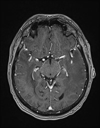 Cerebral amyloid angiopathy-related inflammation (Radiopaedia 58270-65377 Axial T1 C+ fat sat 62).jpg