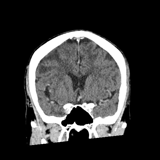 Cerebral amyloid angiopathy-related inflammation (Radiopaedia 74836-85848 Coronal non-contrast 29).jpg