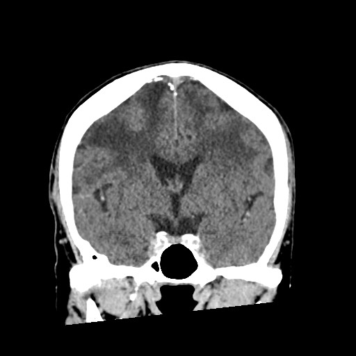 Cerebral amyloid angiopathy-related inflammation (Radiopaedia 74836-85848 Coronal non-contrast 33).jpg