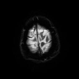 Cerebral amyloid angiopathy (Radiopaedia 28698-28978 Axial DWI 56).jpg