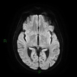 Cerebral amyloid angiopathy (Radiopaedia 77506-89664 Axial DWI 14).jpg