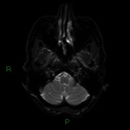 Cerebral amyloid angiopathy (Radiopaedia 77506-89664 Axial DWI 33).jpg