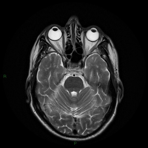 File:Cerebral amyloid angiopathy (Radiopaedia 77506-89664 Axial T2 10).jpg