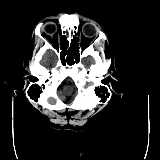 Cerebral amyloid angiopathy (Radiopaedia 77506-89665 Axial non-contrast 15).jpg