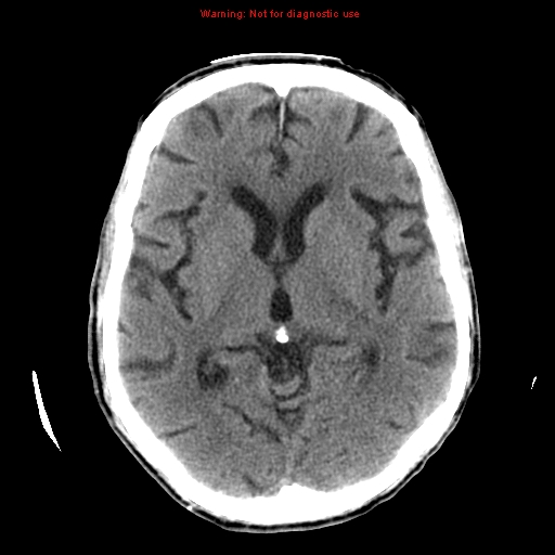 File:Cerebral and orbital tuberculomas (Radiopaedia 13308-13310 Axial non-contrast 14).jpg