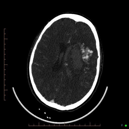 Cerebral arteriovenous malformation (AVM) (Radiopaedia 78162-90706 Axial CTA 173).jpg
