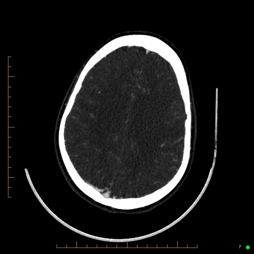 Cerebral arteriovenous malformation (AVM) (Radiopaedia 78162-90706 Axial CTA 198).jpg