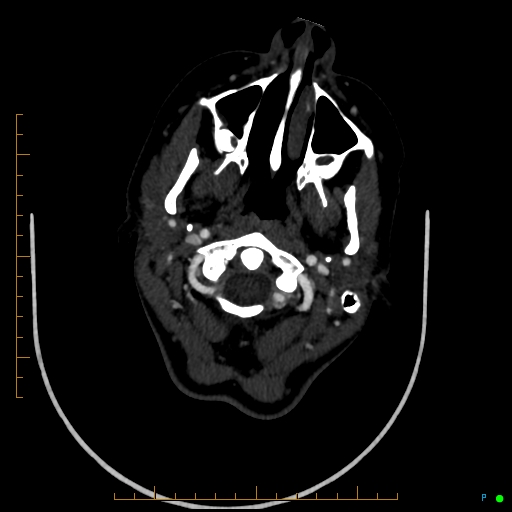Cerebral arteriovenous malformation (AVM) (Radiopaedia 78162-90706 Axial CTA 35).jpg