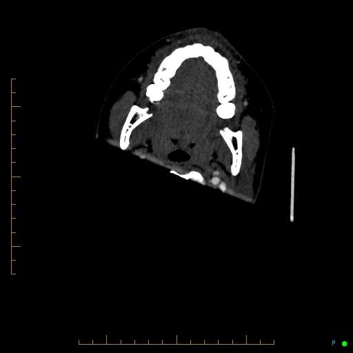 Cerebral arteriovenous malformation (AVM) (Radiopaedia 78162-90706 Axial CTA 6).jpg