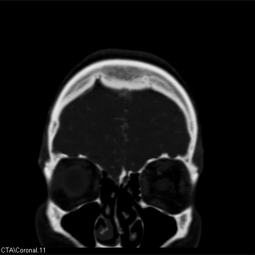 Cerebral arteriovenous malformation (Radiopaedia 28518-28759 C 11).jpg