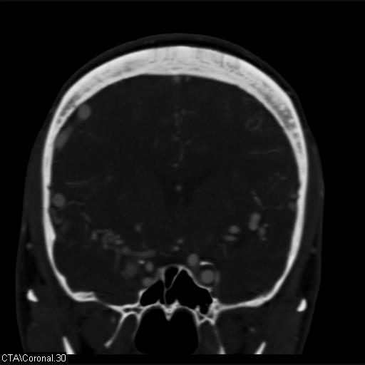 Cerebral arteriovenous malformation (Radiopaedia 28518-28759 C 30).jpg