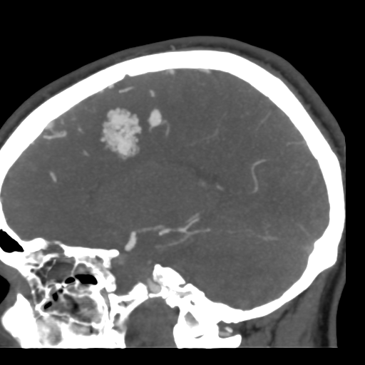 Cerebral arteriovenous malformation (Radiopaedia 39259-41505 Sagittal 25).png