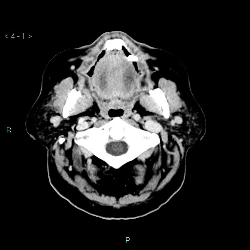 File:Cerebral arteriovenous malformation (Radiopaedia 40528-43125 Axial C+ delayed 1).jpg