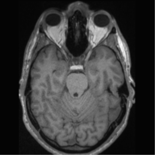 Cerebral arteriovenous malformation (Radiopaedia 55798-62372 Axial T1 21).png