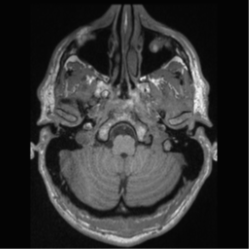 Cerebral arteriovenous malformation (Radiopaedia 55798-62372 Axial T1 7).png