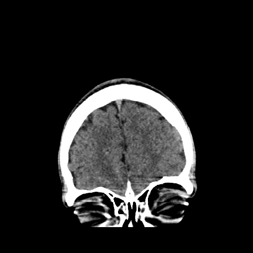 File:Cerebral arteriovenous malformation (Radiopaedia 61964-70028 Coronal non-contrast 10).jpg