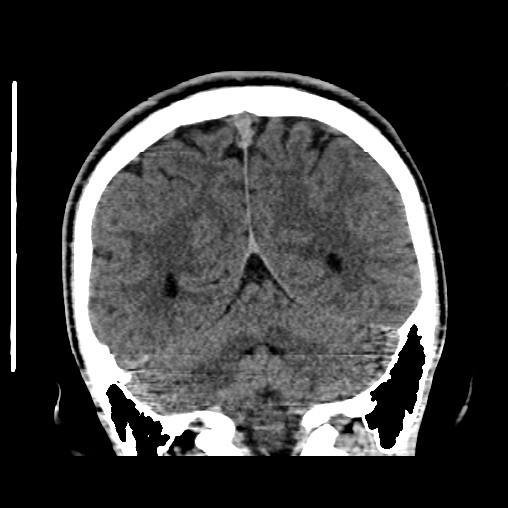 File:Cerebral arteriovenous malformation (Radiopaedia 61964-70028 Coronal non-contrast 44).jpg