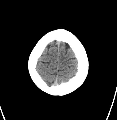 File:Cerebral arteriovenous malformation (Radiopaedia 74411-85744 Axial non-contrast 32).jpg