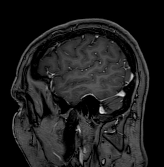 Cerebral arteriovenous malformation (Radiopaedia 74411-85746 Sagittal T1 C+ 15).jpg