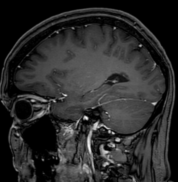 Cerebral arteriovenous malformation (Radiopaedia 74411-85746 Sagittal T1 C+ 38).jpg