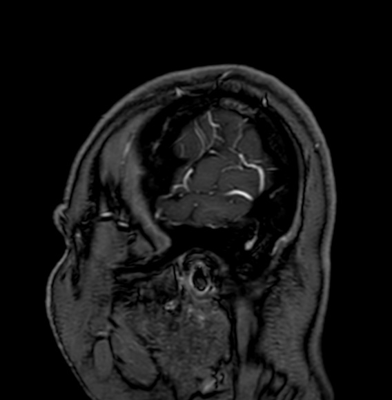 Cerebral arteriovenous malformation (Radiopaedia 74411-85746 Sagittal T1 C+ 5).jpg