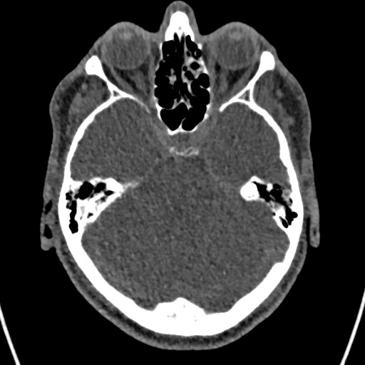 File:Cerebral arteriovenous malformation (Radiopaedia 78188-90746 Axial non-contrast 54).jpg