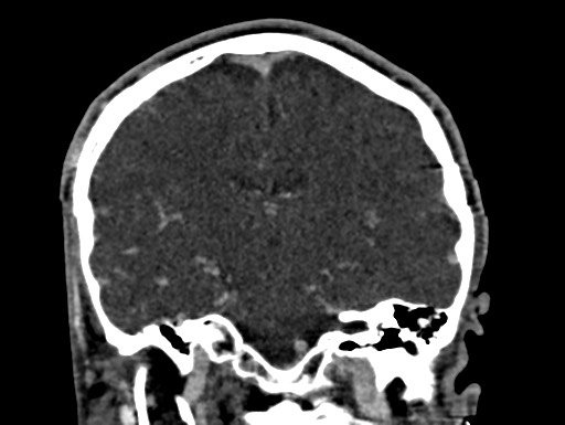 Cerebral arteriovenous malformation (Radiopaedia 78188-90746 Coronal C+ delayed 65).jpg