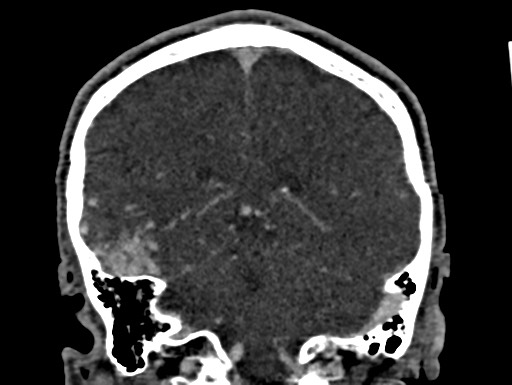 Cerebral arteriovenous malformation (Radiopaedia 78188-90746 Coronal C+ delayed 80).jpg