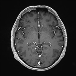 Cerebral arteriovenous malformation (Radiopaedia 84015-99245 Axial T1 C+ 75).jpg