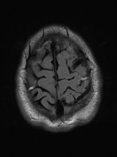 File:Cerebral arteriovenous malformation - huge (Radiopaedia 35734-37272 Axial FLAIR 21).png
