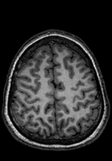 Cerebral arteriovenous malformation at posterior body of corpus callosum (Radiopaedia 74111-84925 Axial T1 55).jpg